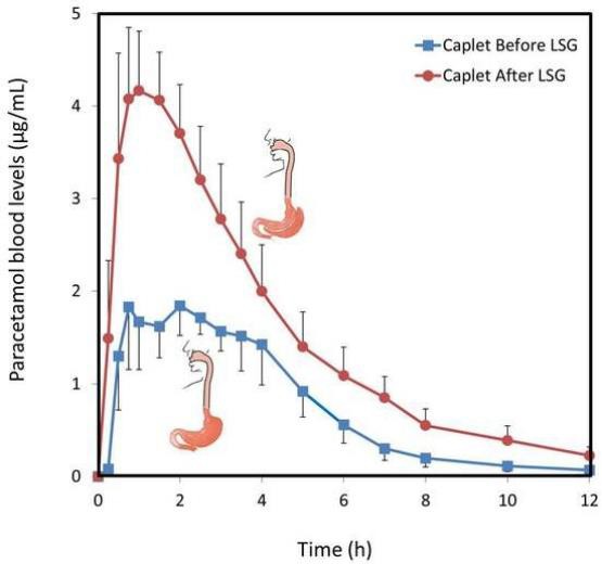 Increased Paracetamol Bioavailability after Sleeve Gastrectomy Increased Paracetamol Bioavailability after Sleeve Gastrectomy