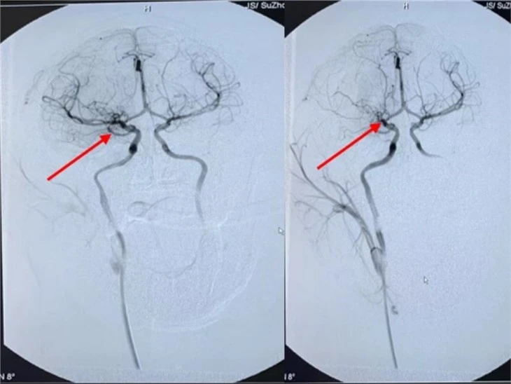 Modelo NHP de oclusão da artéria cerebral média (MCAO) de Stoke e isquemia cerebral