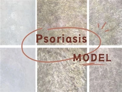 Modelo de psoríase